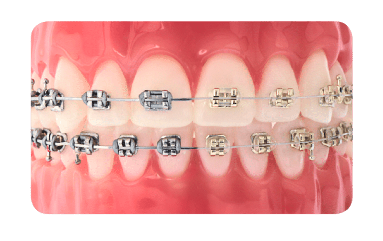 Braces HomeTown Orthodontics in South Hill, VA