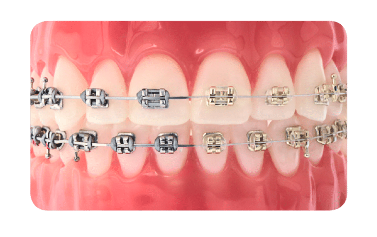 Metal Braces VS Clear Braces - Bali Implant Aesthetic (BIA) Dental Center