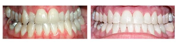 Before and after treatment HomeTown Orthodontics in South Hill, VA