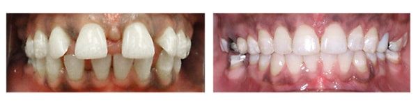 Before and after HomeTown Orthodontics in South Hill, VA