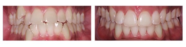 Before and after HomeTown Orthodontics in South Hill, VA